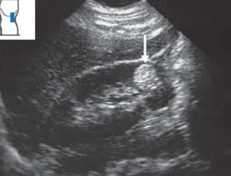 Kidneys and Adrenal Glands