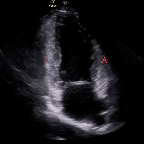 hypokinetic anterior wall