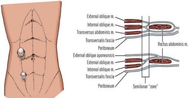 spigelian hernia anatomy