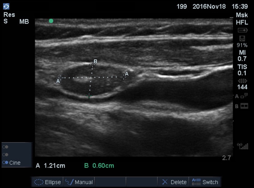 groin lymph nodes ultrasound